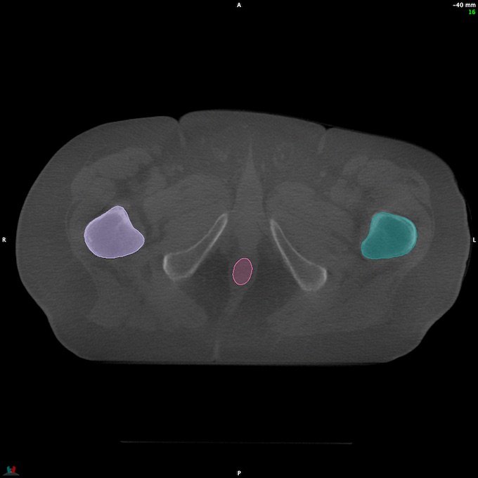CT__RECTUM_CBCT_38