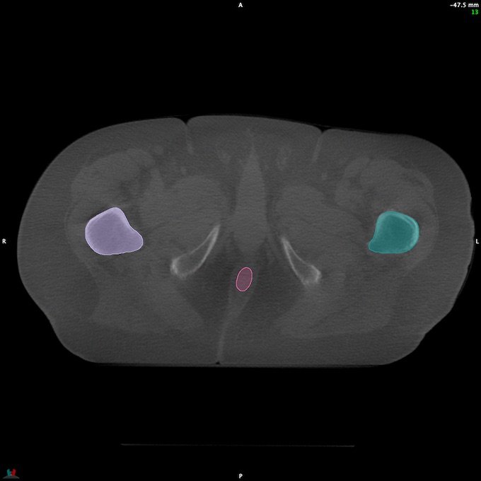 CT__RECTUM_CBCT_41