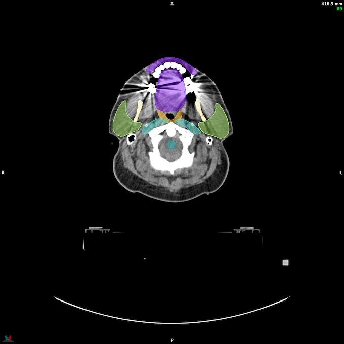 CT__SPINALCORD_0