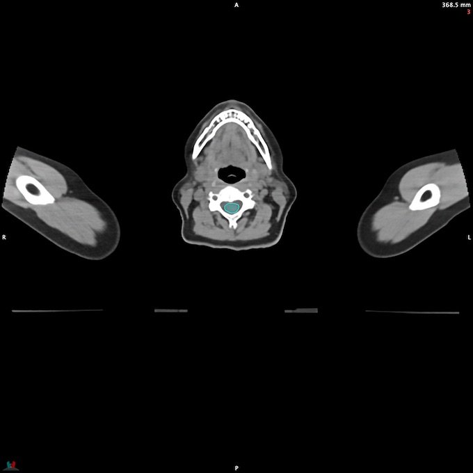 CT__SPINALCORD_1