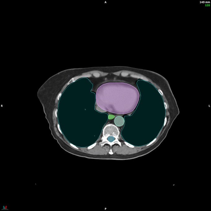 CT__SPINALCORD_119