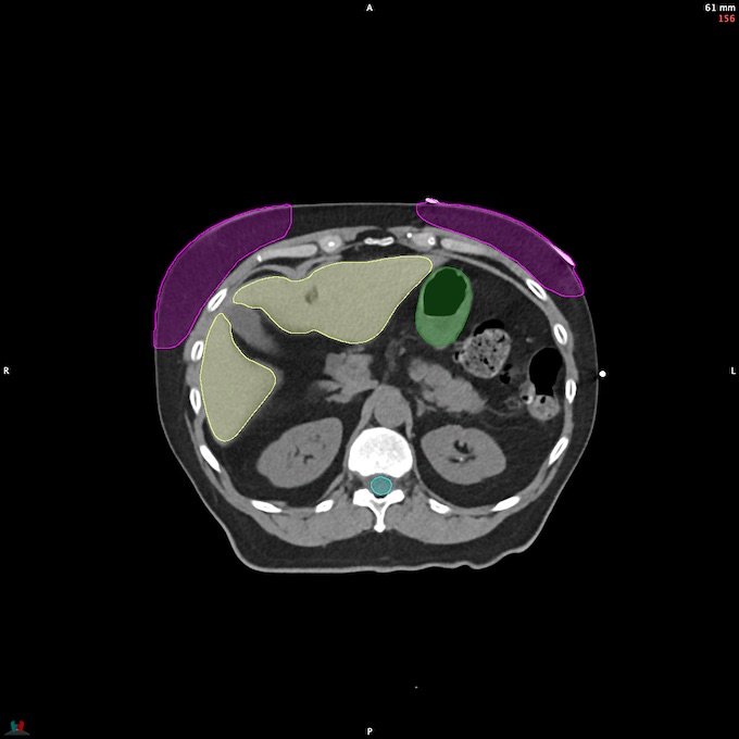 CT__SPINALCORD_124