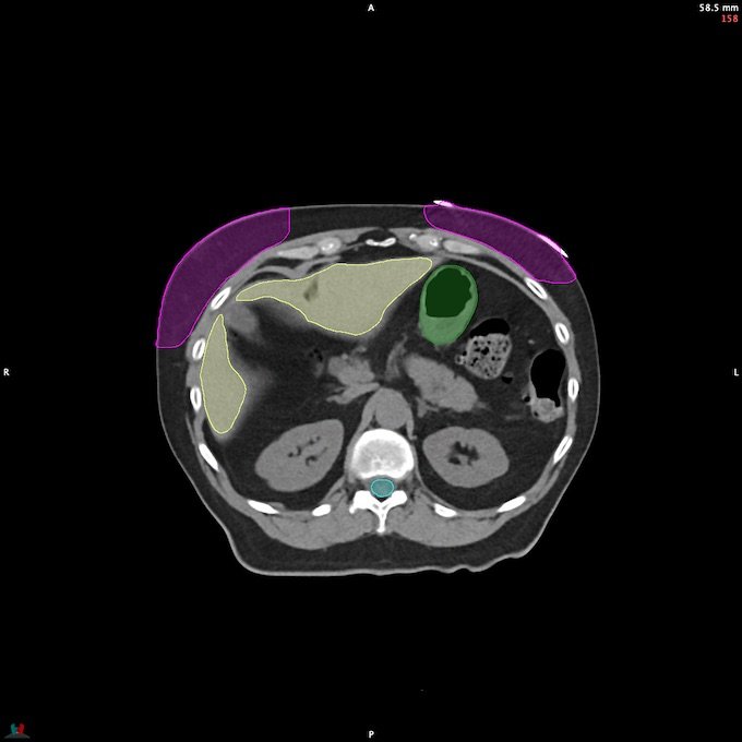 CT__SPINALCORD_125