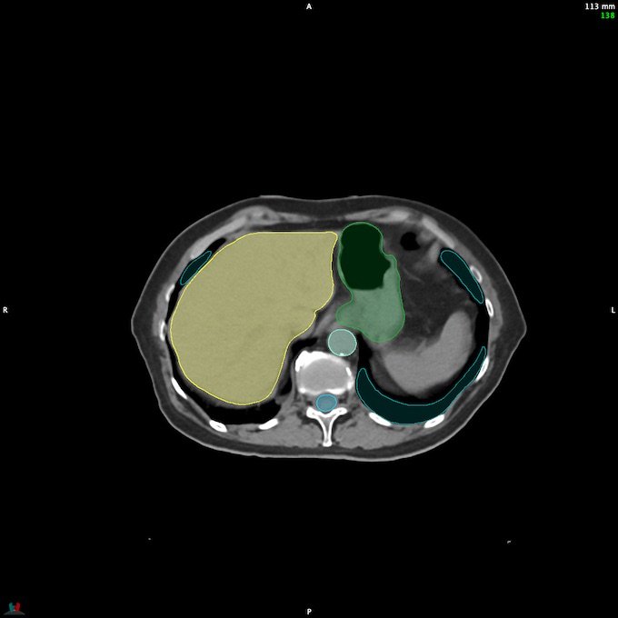CT__SPINALCORD_137