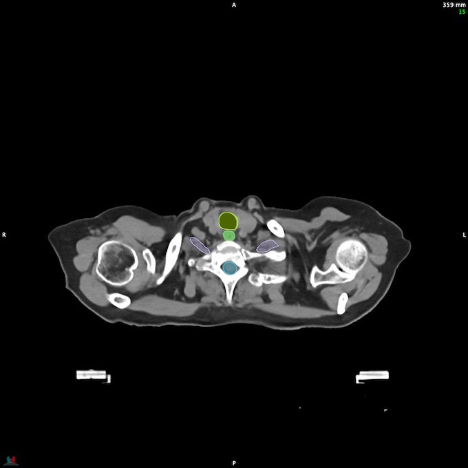 CT__SPINALCORD_14
