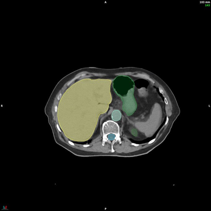 CT__SPINALCORD_142