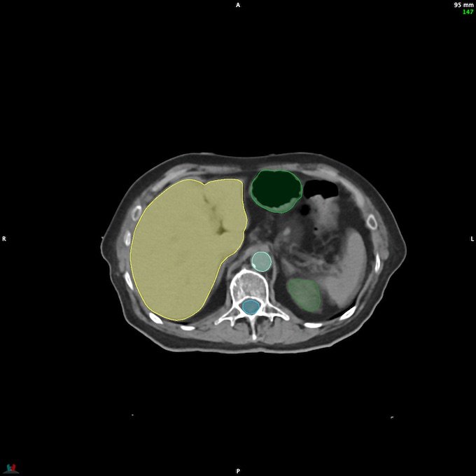 CT__SPINALCORD_146