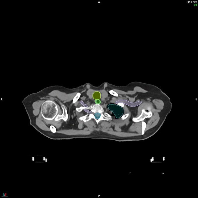 CT__SPINALCORD_18