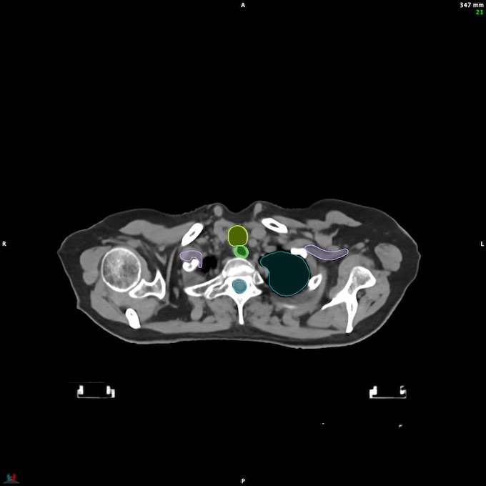 CT__SPINALCORD_20