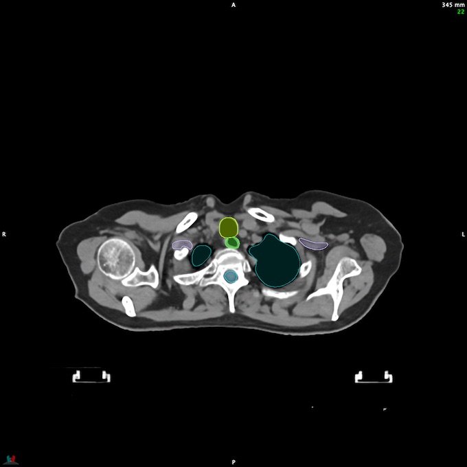 CT__SPINALCORD_21