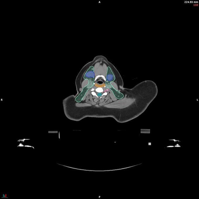 CT__SPINALCORD_26