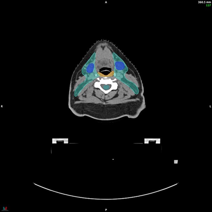CT__SPINALCORD_28