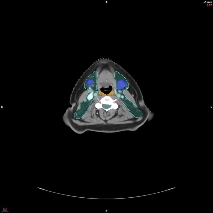 CT__SPINALCORD_30