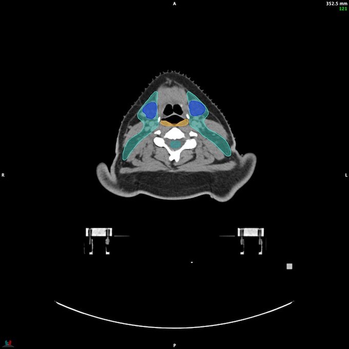 CT__SPINALCORD_32