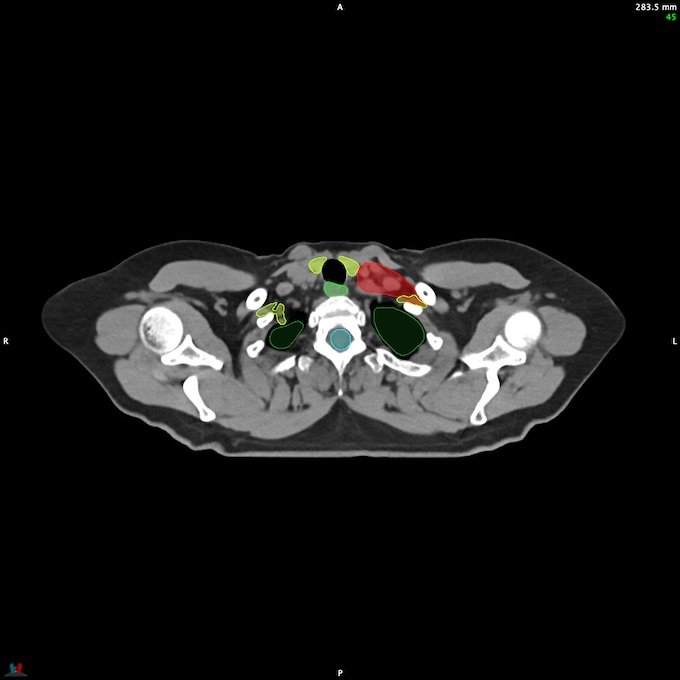CT__SPINALCORD_35