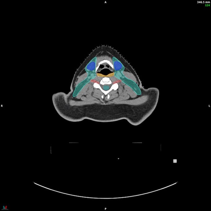 CT__SPINALCORD_35