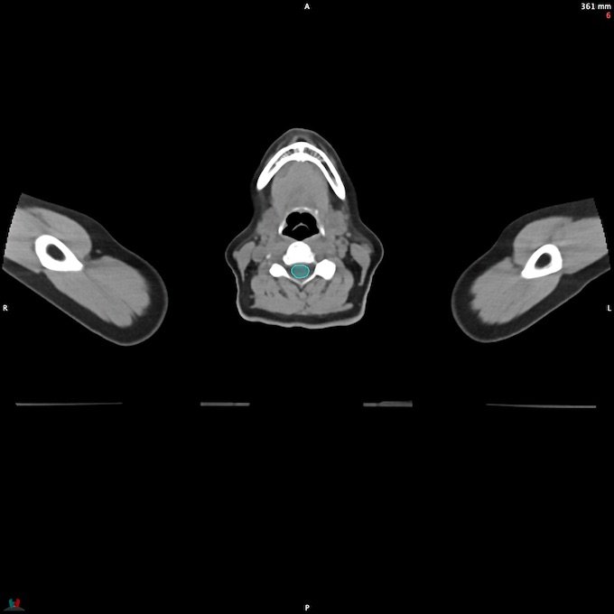 CT__SPINALCORD_4