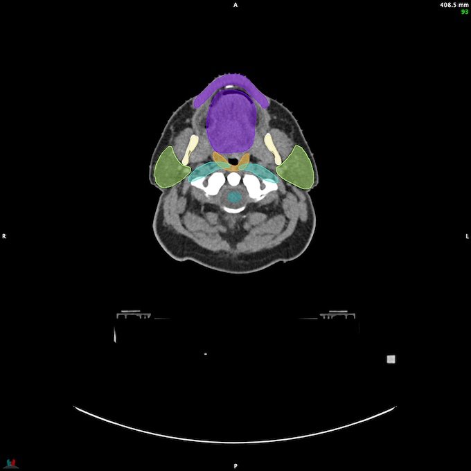 CT__SPINALCORD_4
