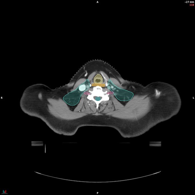 CT__SPINALCORD_41