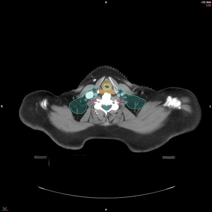 CT__SPINALCORD_43