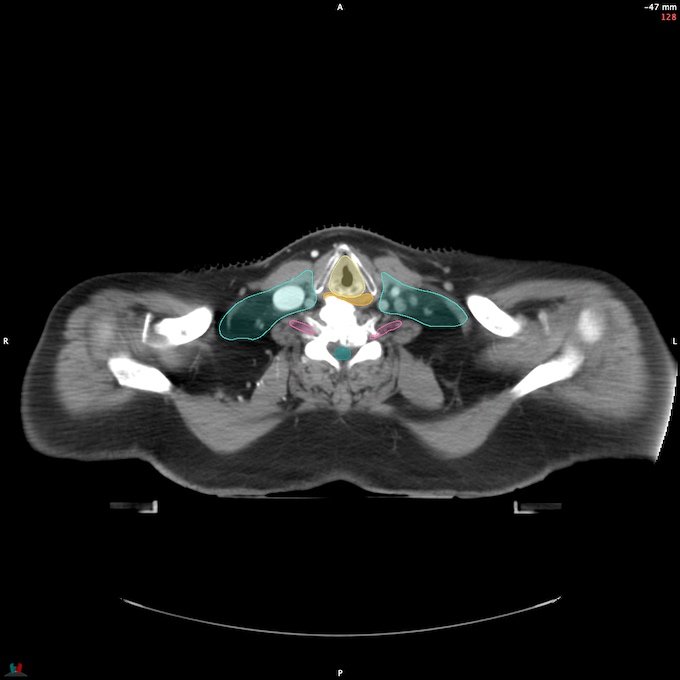 CT__SPINALCORD_51