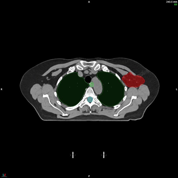 CT__SPINALCORD_51