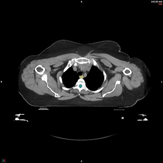 CT__SPINALCORD_62