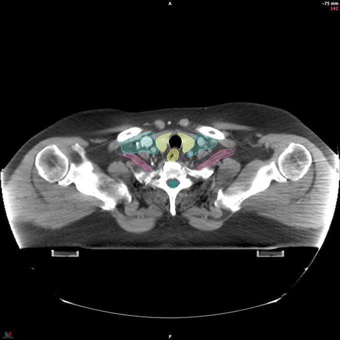CT__SPINALCORD_65