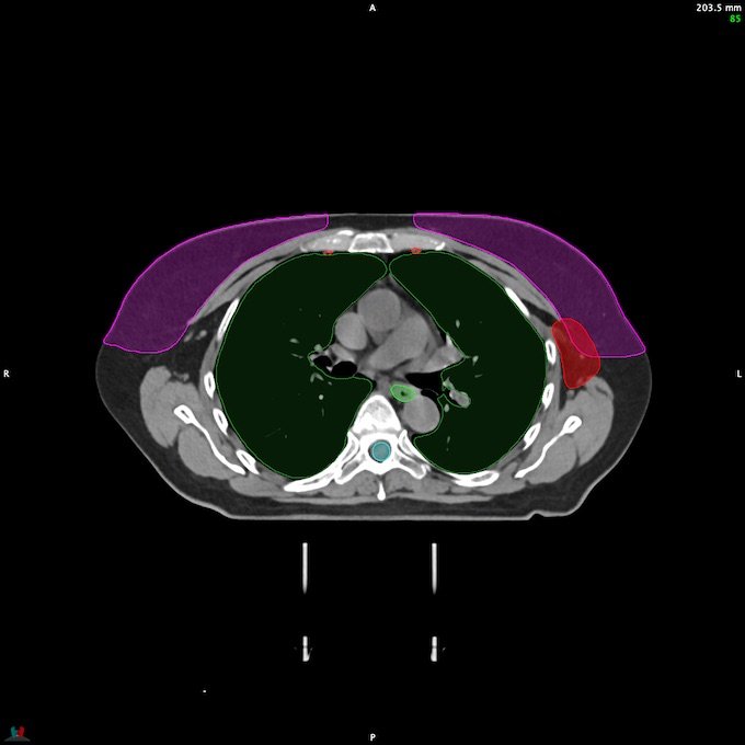 CT__SPINALCORD_67
