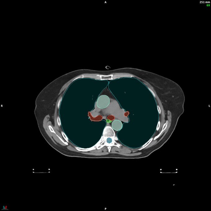 CT__SPINALCORD_68