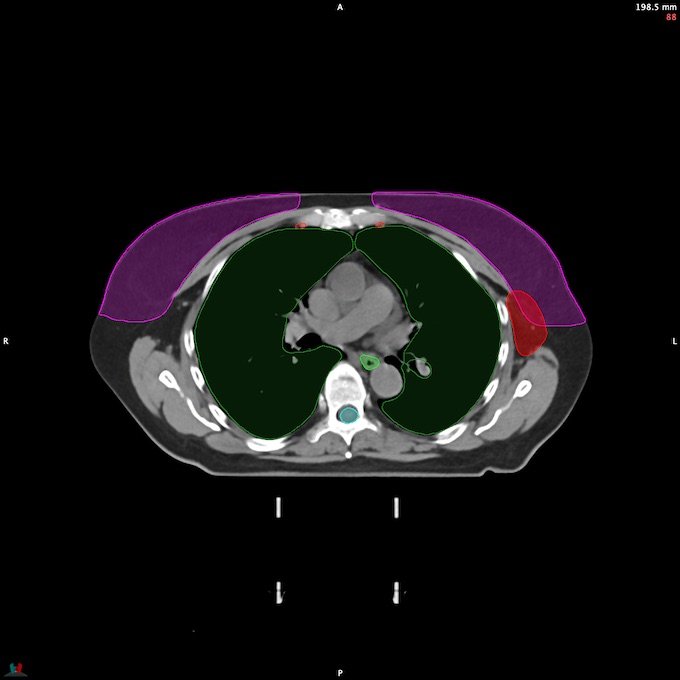 CT__SPINALCORD_69