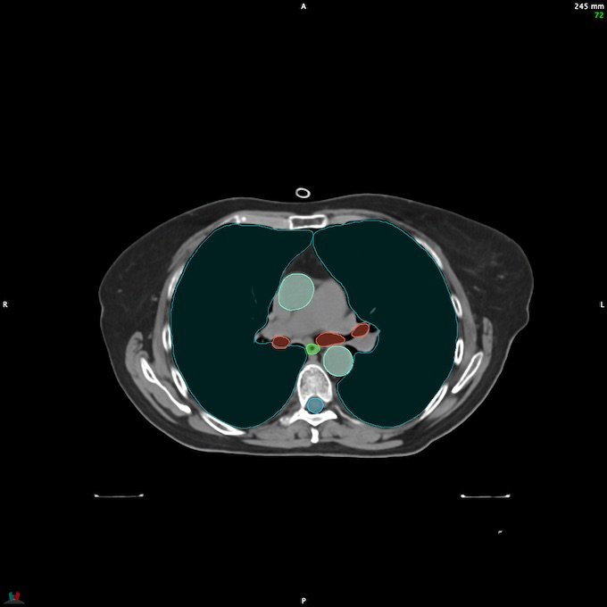 CT__SPINALCORD_71