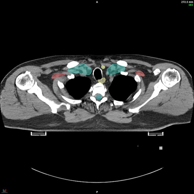 CT__SPINALCORD_72