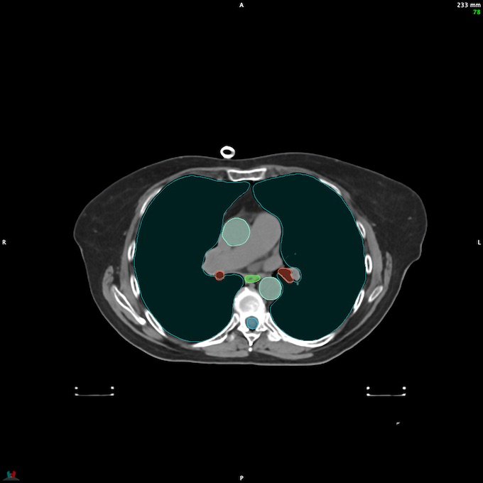 CT__SPINALCORD_77