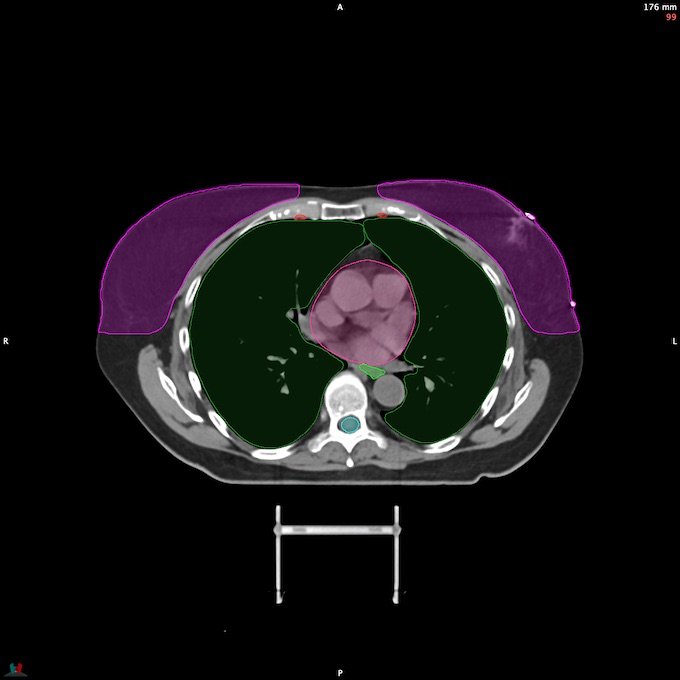 CT__SPINALCORD_78