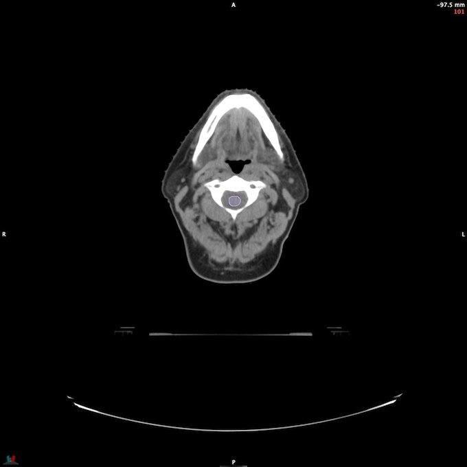 CT__SPINALCORD_8
