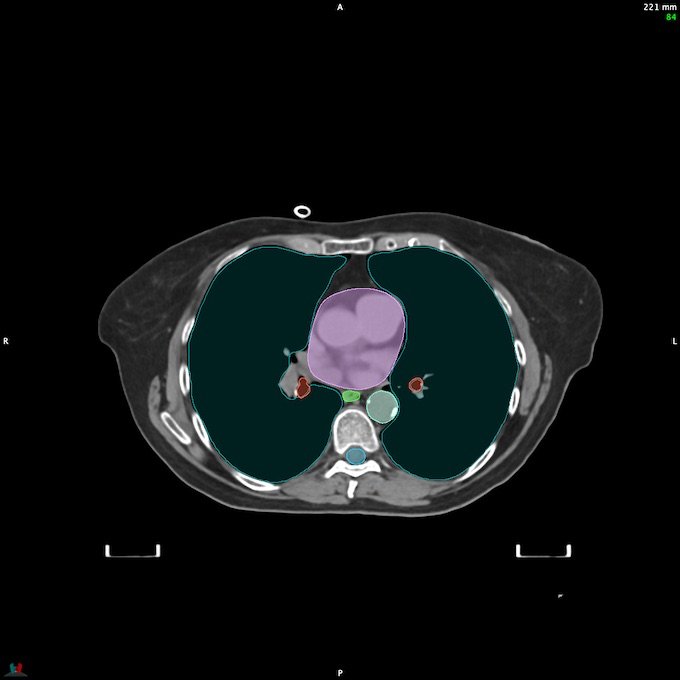 CT__SPINALCORD_83