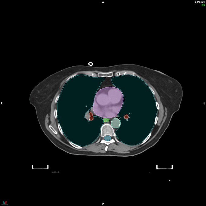 CT__SPINALCORD_84