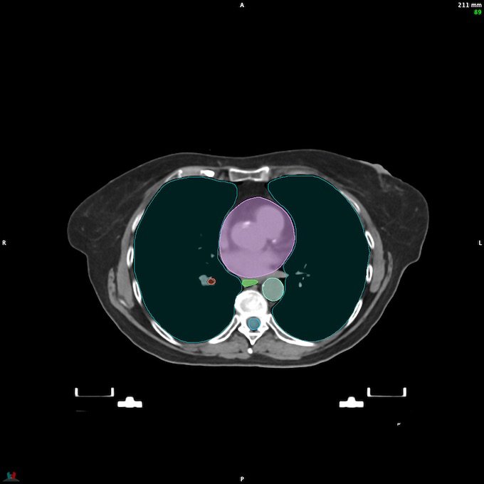 CT__SPINALCORD_88
