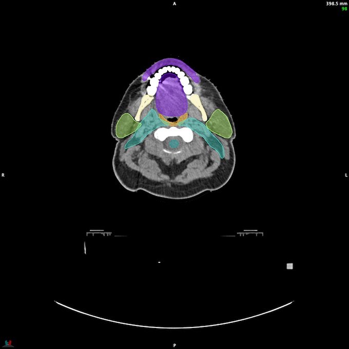 CT__SPINALCORD_9