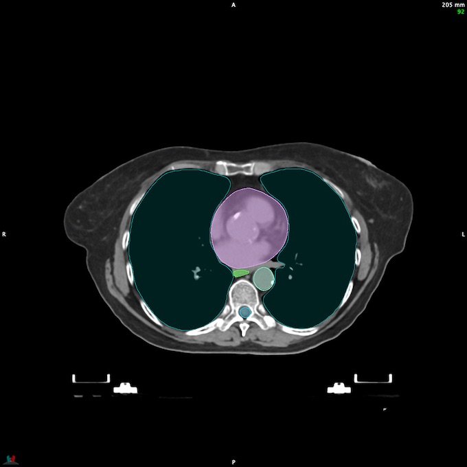 CT__SPINALCORD_91