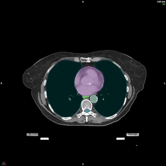CT__SPINALCORD_94