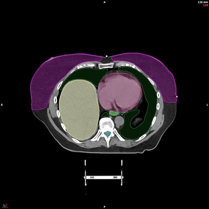 CT__SPINALCORD_94