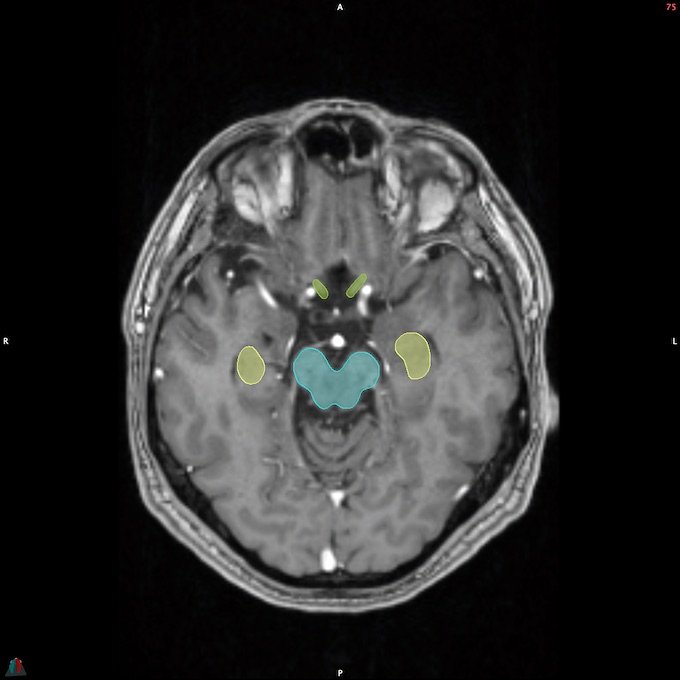 MR__BRAINSTEM_3