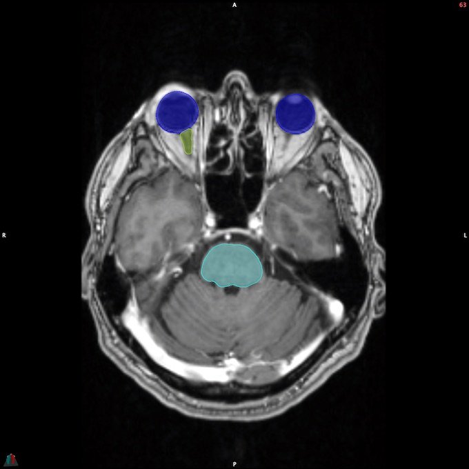 MR__BRAINSTEM_8