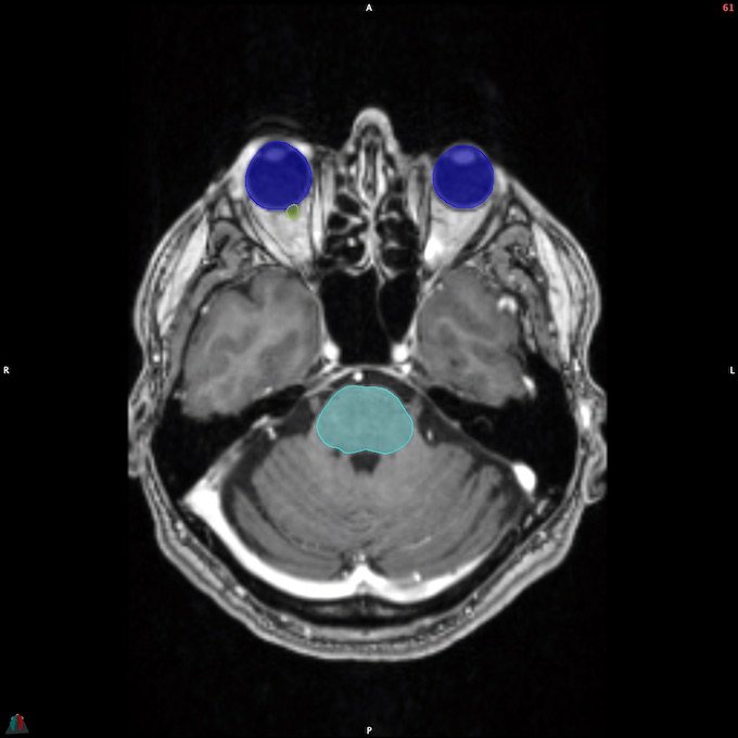 MR__BRAINSTEM_9